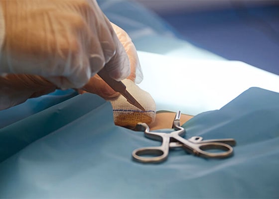 包茎手術のイメージ